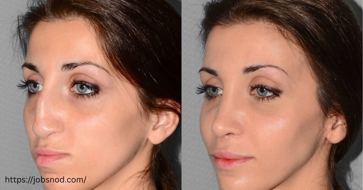 how much is a nose job